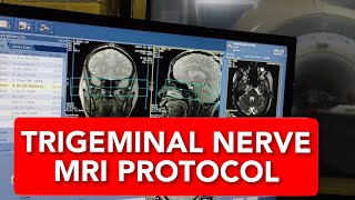 Trigeminal Nerve MRI scan protocol positioning and planning [upl. by Dumond]