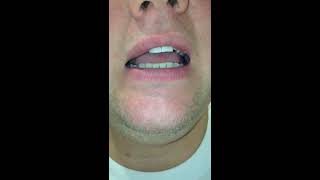 Me And My Tonsil Stones Episode 6 Flush Them Out [upl. by Constancia]