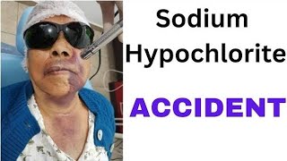 RCT complications  sodium hypochlorite accident and air emphysema [upl. by Adnac]