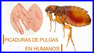 picaduras de pulgas en humanos remedios y tratamientos [upl. by Sivram]