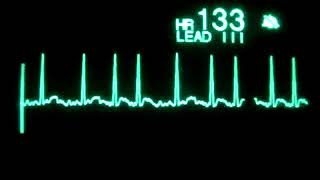 Fibrilación Auricular con Respuesta Ventricular Rápida [upl. by Pontone670]