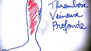 SmartNEasy  Thrombose veineuse profonde  Dr Astuce [upl. by Razid]