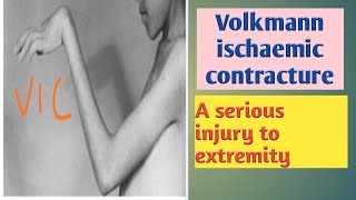 VIC IN HINDIVOLKMANN ISCHAEMIC CONTACTURE IN FOREARM IN HINDIHANDVIC IN FOREARM in hindi [upl. by Adnohsal]