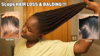 Use This Once a Week and Your Hair Will Never Stop Growing DIY for HAIR LOSS amp BALDING‼️ [upl. by Ignatzia]