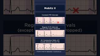 Type II Second Degree Atrioventricular Block ECG AV conduction ratio [upl. by Nho952]