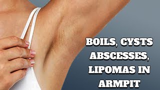 Common Causes of Pain amp Lumps in Armpit  Boils Cysts Lipomas [upl. by Lynd]