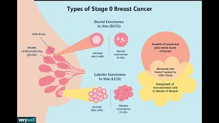 Treatment of Ductal Carcinoma in Situ [upl. by Vargas]