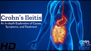 Crohn’s Ileitis Unveiled Causes Symptoms and Treatment Explored [upl. by Elnukeda817]