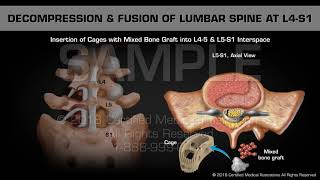 Decompression amp Fusion of Lumbar Spine at L4S1 [upl. by Dhu643]