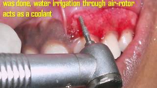 Gingival Depigmentation Procedure Using Diamond Bur Case By Dr Akash Akinwar [upl. by Christye]