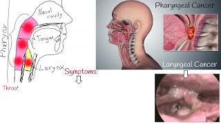 Throat cancer  Symptoms causes and Treatment Laryngeal Cancer and Pharyngeal Cancer [upl. by Sherline280]