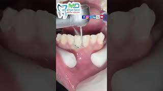 Teeth Composite filling [upl. by Harold]