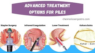 HOW MANY ADVANCE TREATMENTS ARE AVAILABLE FOR PILES TREATMENTS [upl. by Daigle778]