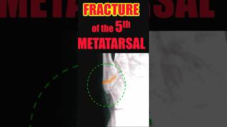 Fracture of the 5th Metatarsal trauma radiology doctor [upl. by Yeslah574]