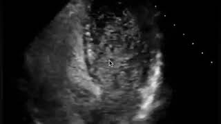 Bubble study on echo  PFO  The Echo Clip [upl. by Tellford]