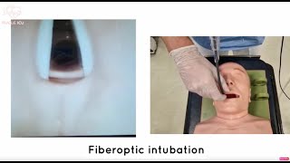 Fiberoptic intubation [upl. by Roscoe903]