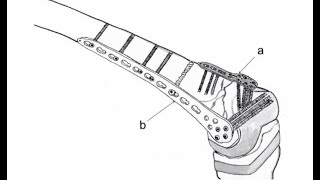 DUAL PLATING amp BONE GRAFT SUBSTITUTE FOR FAILED OSTEOSYNTHESIS IN DISTAL FEMUR OSTEOSARCOMA IN 15M [upl. by Terhune]