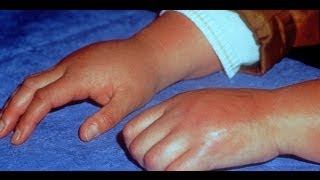 Learn About Reflex Sympathetic Dystrophy  Also Known as Reflex Pain [upl. by Stephania]