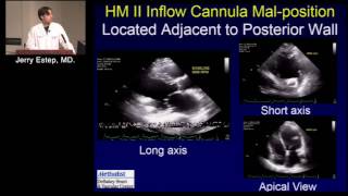 Imaging the Patient with LVAD Jerry Estep MDSu Min Chang MD January 31 2017 [upl. by Aerua]