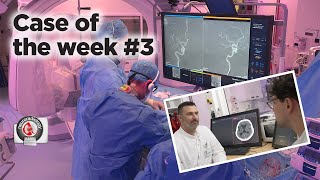 Case of the week 3  CTPerfusion and ADAPTQUATTRO for MeVO occlusions [upl. by Dehlia]