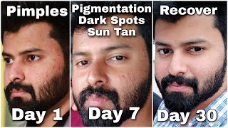 Do you have Dark Spots Pigmentation Just follow this for 100  gauranteed Result 👍  Tamil [upl. by Schuler611]