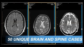 Brain amp Spine Neuroradiology Remote Fellowship  Dr David Yousem [upl. by Cila]