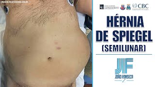 HÉRNIAS ABDOMINAIS Parte 6 SPIEGEL SEMILUNAR 👨🏽‍⚕️🚑 Joao Fonseca Cir Geral [upl. by Luigino]