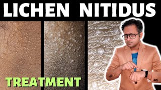 Lichen nitidus  Treatment  Hindi [upl. by Oreves998]