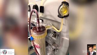 PLASMA EXCHANGE THERAPY PLASMAPHERESIS TUTORIAL [upl. by Ansev807]