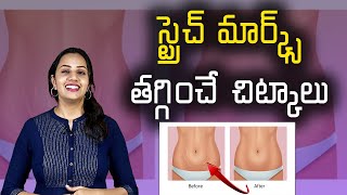 Tips to Get Rid of Stretch Marks ఈ టిప్స్‌తో స్ట్రెచ్‌ మార్క్స్‌ మాయంSamayamTelugu [upl. by Ayamat]