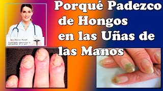 Porque Aparecen Hongos en las Uñas de las Manos Doctora Valeria Peroski [upl. by Anit466]