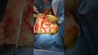 Opening the Pericardium  beating heart  liver transplant [upl. by Wenona]