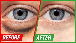 How to Get Rid of Puffy Eyes and Dark Circles [upl. by Tatianas673]