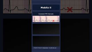 Type II Second Degree Atrioventricular Block ECG Constant PR intervals [upl. by Min]