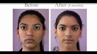 How to get rid of acne l Before amp After treatment [upl. by Siravaj742]