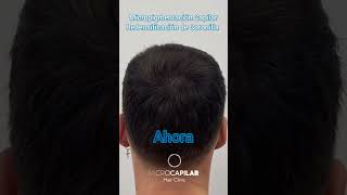 Micropigmentación capilar con Efecto de Redensificación de la Coronilla en Microcapilar Hair Clinic [upl. by Maressa]