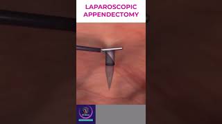 Laparoscopic Appendectomy  Appendicitis Treatment [upl. by Airlee577]