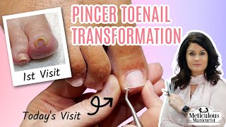 Pincer Ingrown Toenail Transformation How to Pedicure [upl. by Uzzial]