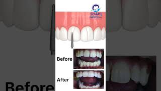 Before amp After Filling Gaps Between Teeth  Shahi Dental Clinic Muzaffarpur [upl. by Ellard]