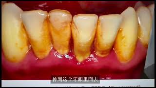 deep tooth cleaning深度清洁牙齿，牙周刮治 [upl. by Suirauqram26]