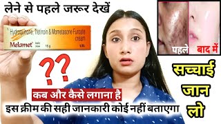 Melamet CreamUsesSide effectsReviewMelamet Cream Remove PigmentationMelasma How to use in Hindi [upl. by Aihtenak]