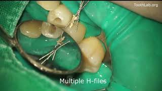 Root canal retreatmentGutta percha removal [upl. by Bonina]