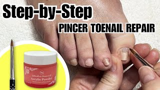 Fix Trumpet Toenail at Home  How to Use Pincer Toenail Kit nails satisfying [upl. by Helli]