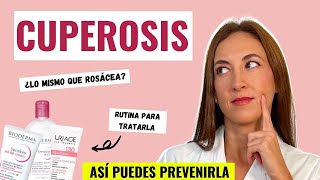 ⏩ ¿Qué es la CUPEROSIS ¿Cómo se TRATA 🤔  PRODUCTOS que RECOMIENDO ✅⚡ [upl. by Aihsas]