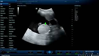 Achondroplasia associated with Hydrocephalus  Diagnostic ultrasound cases [upl. by Irisa]