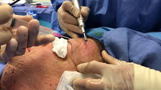 Surgeon Explains Dermabrasion for Cutaneous Neurofibromas [upl. by Weinhardt]