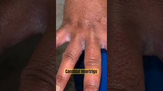 Candidal Intertrigo dermatology medicaleducation medical skincare doctor [upl. by Ozzy]