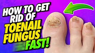 How to Grow Toe Nails Healthy and Fast IMPORTANT STEPS Toenail Growth Journey  Rose Pearl [upl. by Amalle425]