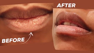 DRY CHAPPED PEELING LIPS REMEDY IN MINUTES This Hack is a Game Changer [upl. by Tertius]