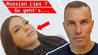 Lippen aufspritzen mit Hyaluronsäure  Russian Lips  Vorher Nachher [upl. by Kylah]